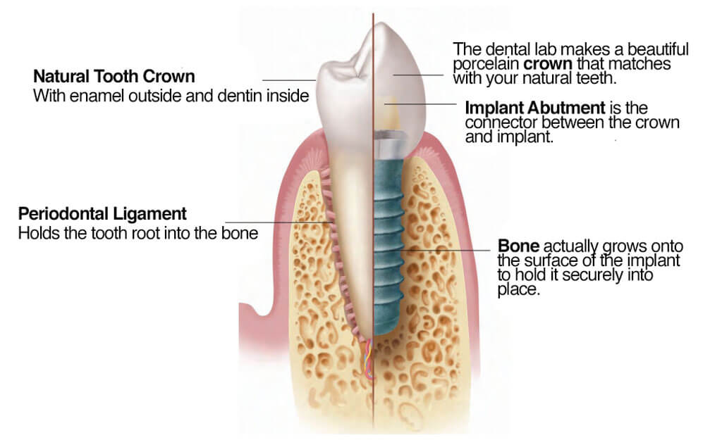 Best   Dental Implants Quotes Near Me 
 thumbnail
